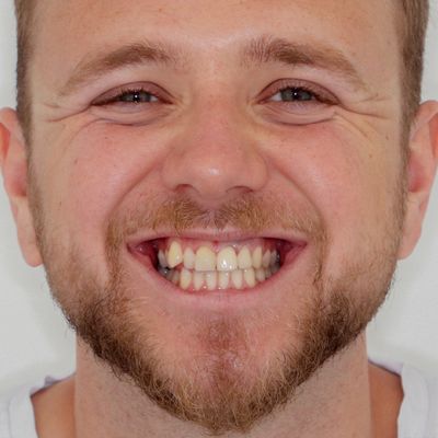 Invisalign - Smile 11 before